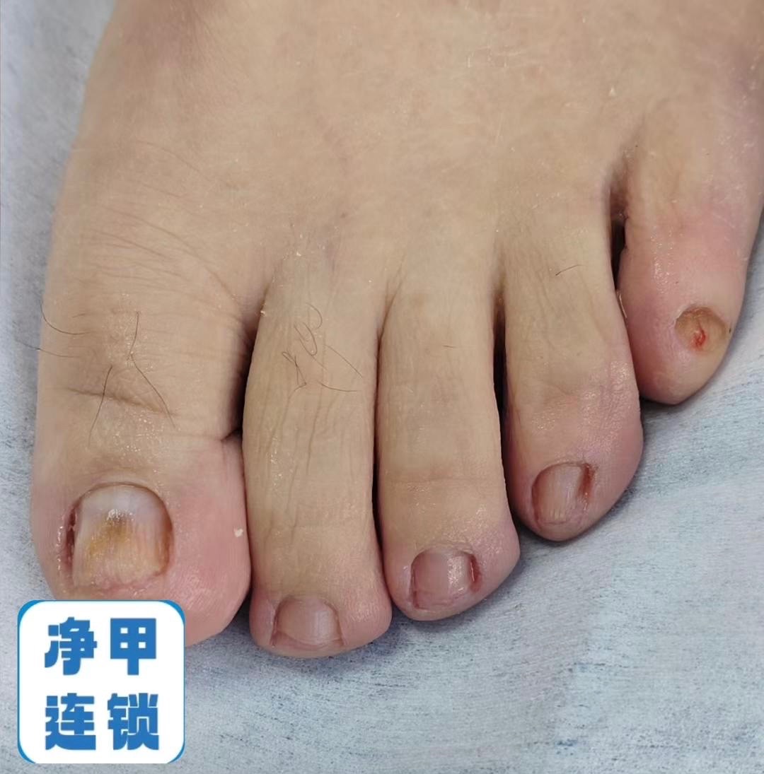 净甲连锁·新店开业 中药泡脚+专业修脚+润肤护理特价19元 康复全单八折 储值会员送价值98元脚气抑菌液